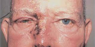 Que Es La Culebrilla Herpes Zoster American Academy Of Ophthalmology