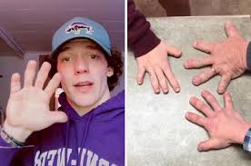 19 Things You Ll Only Understand If You Have Clubbed Thumbs