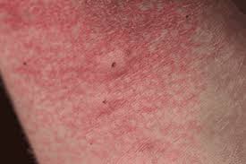 Image result for wolf spider bite skin