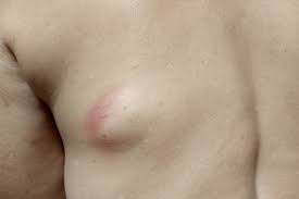 Image result for Cyst