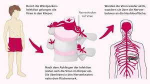 Gürtelrose äußert sich als hautausschlag & ist hoch ansteckend. Gurtelrose Alles Dazu Im Zur Rose Ratgeber