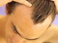 What Is The Estimated Age When People Start Suffering From Hair Loss Hair Transplant Dubai Hair Loss Hair Loss Medication Hair Loss Remedies