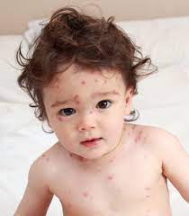 Childhood Diseases – On a Mission to Educate: Reye's Syndrome ...