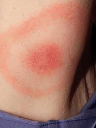Boleh dijangkiti di seluruh kawasan pada badan tetapi kebiasaannya pada muka, badan dan leher. Waspada 6 Jenis Ruam Kulit Ini Ternyata Pertanda Penyakit Serius Global Liputan6 Com