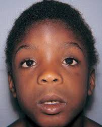 👉🏿Fetal Alcohol Syndrome 👈🏿 (Definition) Fetal alcohol syndrome (FAS)  is a pattern of birth defects, learning, and behavioral problems affecting  individuals whose mothers consumed alcohol during pregnancy. Description  FAS is the most