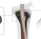 GEMINUS® Distal Radius Plate - Skeletal Dynamics