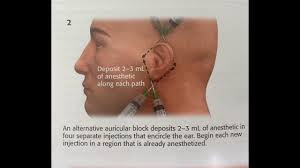Image result for Ear Nerve Block