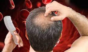 It's completely normal for some hair to fall out during everyday washing and brushing. Iron Deficiency Anaemia Hair Loss Could Be A Sign Of The Condition Express Co Uk