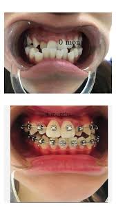 Hal ini disebabkan jenis braces yang dipakai serta servis yang ditawarkan mempengaruhi harga braces gigi. 4 Months Progress With Our Self Klinik Pergigian Kheng Facebook