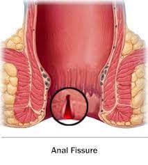 Here's some information to help you get ready for your appointment. Fissure Treatment Clinic Surgeon Laser Surgery