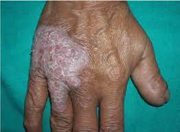 Lupus vulgaris (also known as tuberculosis luposa) are painful cutaneous tuberculosis skin lesions with nodular appearance, most often on the face around the nose, eyelids, lips, cheeks, ears and neck. Cutaneous Lupus Vulgaris Bringing The Wolf Out Of The Darkness