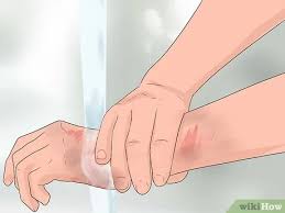 3 doctor answers • 4 doctors weighed in. How To Treat Road Rash With Pictures Wikihow