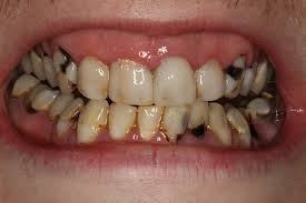 A cracked tooth may or may not involve the root, so every effort to avoid contact with the tooth should be made in order to prevent the tooth from cracking further and potentially causing a root fracture. Rotten Teeth Gum Care Tooth Decay Gum Health