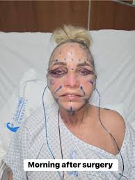 Face-lift & Neck-lift Support Group