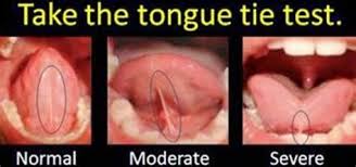 Image result for Ankyloglossia