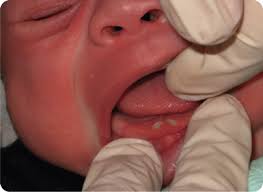 Image result for Neonatal Teeth