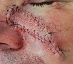 Image result for skin cancer on nose pimple