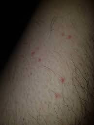 Red dots on legs usually occur as a symptom of some other mild or severe underlying condition. Small Red Spots On Skin Jameslemingthon Blog
