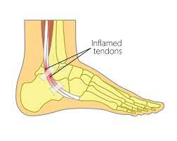 Tendon tear in the elderly is usually caused by a medical condition like gout or a thyroid disorder. Peroneal Tendon Tear Upswing Health