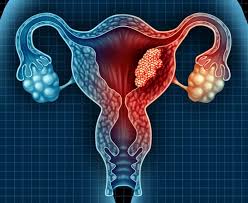 Rahim lenfleri ile ilgili sorular, makaleler ve videolar uzman doktorlar tarafından hazırlanıyor. Endometrium Rahim Kanseri Prof Dr Mustafa Benekli Onkoloji Doktoru Ankara Ic Hastaliklari Uzmani