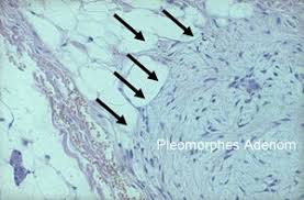 Pleomorphes Adenom