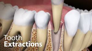 Image result for Tooth Extraction