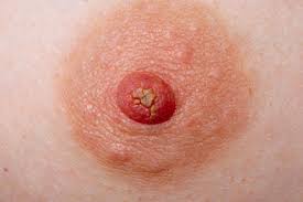 Red flag symptoms - Nipple discharge | GPonline