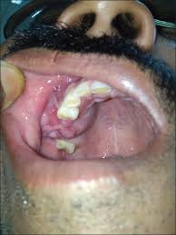 Men are twice as likely to develop mouth cancer compared to women, probably because they're more likely to consume tobacco and alcohol in greater doses and over longer periods of time. 14 Cancer Symptoms In Mouth In Hindi Pictures