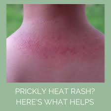 Image result for sweat rash on back