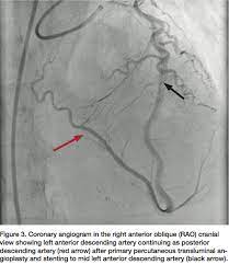 If a patient had arrhythmia. Hyperdominant Left Anterior Descending Artery Continuing As Posterior Descending Artery A Rare Coronary Artery Anomaly Cath Lab Digest