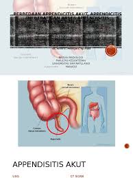 Namun, jika kita tidak menjaga kesehatan dan pola hidup yang sehat maka bersiaplah untuk menerima segala resiko yang. Perbedaan Appendicitis Akut Appendicitis Infiltrat Dan Abses