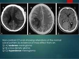 Reading A Brain Ct Scan Ppt Google Search Ct Scan Ppt Brain