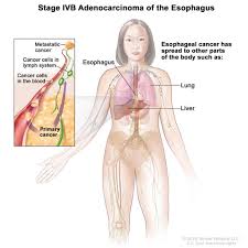 Definition Of Stage Iv Esophageal Adenocarcinoma Nci Dictionary Of Cancer Terms National Cancer Institute