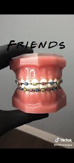 90 S Shows Friends In 2020 Braces Colors Dental Braces Colors Braces Teeth Colors
