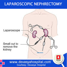 A Kidney Can Be Removed Either Using A Surgical Approach Open Or Laparoscopic Keyhole Surgery To Know Various Adv How To Remove Removal Surgery Pediatrics
