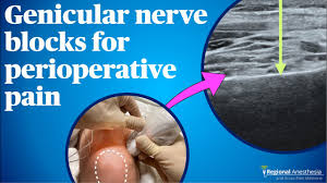 Ultrasound Guided Genicular Nerve Blocks - YouTube