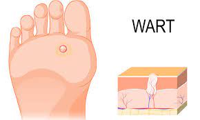 Find out what you need to know about the health benefits of a healthy body. How To Tell If It S A Wart Dr Batra S Homeopathy In Dubai