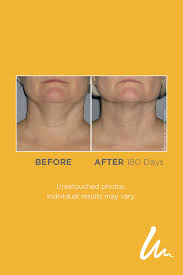 We Re Taking Some Time To Appreciate These Natural Looking Results From Ultherapy Which Occurred Gradually Ultherapy Anti Aging Therapy Ultrasound Technology