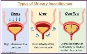 Image result for Overflow Incontinence
