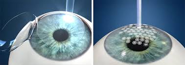 LASIK Boston | LASIK Eye Surgery Boston | NEEC