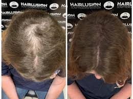 Microart is perfect for men and women, all styles and types of hair. Scalp Micropigmentation Hair Tattooing Hair To Ware