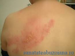 In fapt, ca si varicela, zona zoster este contagioasa. Semnal De Alarma Varicela Face Tot Mai Multe Victime In Randul Adultilor SÄnÄtatea BuzoianÄ