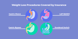 Pin On Weight Loss Surgery Insurance