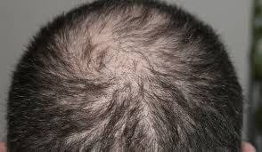 Image result for Alopecia