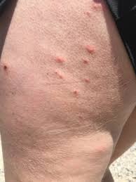 Image result for scabies symptoms