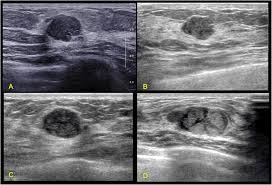 Presenting radiologic appearance of breast dcis microcalcifications at breast cancer screening we can see from the chart above that overall, the most commonly occuring mammographic indication of dcis are the crushed stone microcalcifications. Triple Negative Invasive Breast Carcinoma The Association Between The Sonographic Appearances With Clinicopathological Feature Scientific Reports