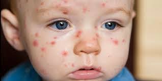 Menggunakan losion calamine secara rutin. 6 Penawar Mudah Untuk Rawatan Cacar Air Chicken Pox Bayi Kanak Kanak Ira Mommy Si Kembar