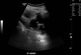 Bilateral simple renal cysts also visualized. Renal Cell Carcinoma On A Background Of Autosomal Dominant Polycystic Kidney Disease Radiology Case Radiopaedia Org