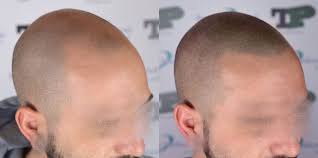 In sostanza con questa tecnica si . Tricopigmentazione Il Tatuaggio Semipermanente Contro La Perdita Dei Capelli Tuttotatuaggi It