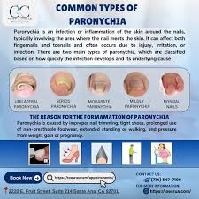 Image result for Paronychia feet